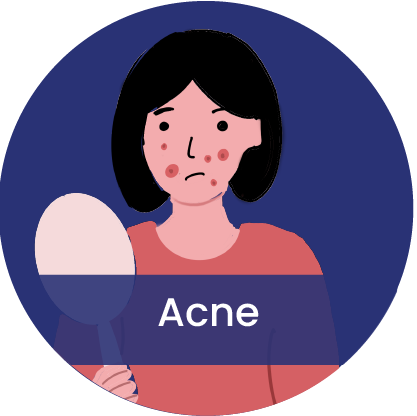 acne - symptom of inflammatory type of PCOS