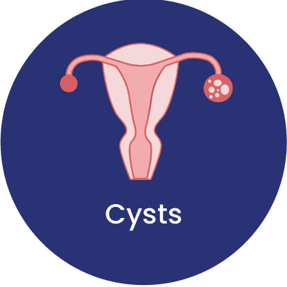 cysts - symptom of inflammatory type of PCOS